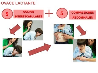 OVACE LACTANTE
5 5GOLPES
INTERESCAPULARES
COMPRESIONES
ABDOMINALES
 