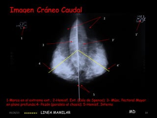 05/26/13 14
Imagen Cráneo Caudal
1
1’
2
3
3’
4
4’
5
1-Marca en el extremo ext.; 2-Hemisf. Ext. (Cola de Spence); 3- Músc. Pectoral Mayor
en plano profundo;4- Pezón (paralelo al chasis); 5-Hemisf. Interno
LINEA MAMILAR MD
 