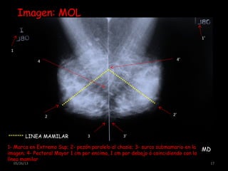 05/26/13 17
Imagen: MOL
LINEA MAMILAR
MD
1
1’
2 2’
3 3’
4 4’
1- Marca en Extremo Sup; 2- pezón paralelo al chasis; 3- surco submamario en la
imagen; 4- Pectoral Mayor 1 cm por encima, 1 cm por debajo ó coincidiendo con la
línea mamilar
 