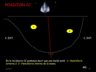 05/26/13 19
C. EXT. C. INT.
POSICION CC
1
En la incidencia CC podemos decir que una lesión está : 1- Hemisferio
externo ó 2- Hemisferio interno de la mama
2
MD
 