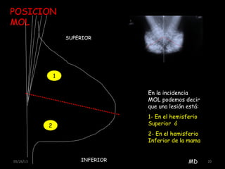 05/26/13 20
POSICION
MOL
SUPERIOR
INFERIOR
1
2
EN
En la incidencia
MOL podemos decir
que una lesión está:
1- En el hemisferio
Superior ó
2- En el hemisferio
Inferior de la mama
MD
 
