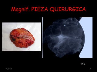 Magnif. PIEZA QUIRURGICA
05/26/13 26
MD
 