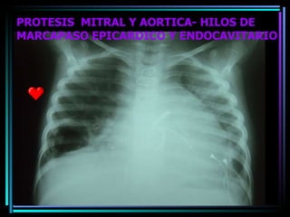 PROTESIS  MITRAL Y AORTICA- HILOS DE MARCAPASO EPICARDICO Y ENDOCAVITARIO 