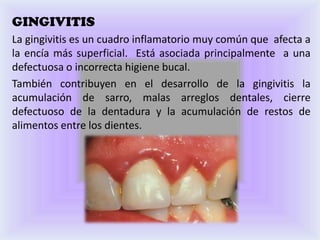 GINGIVITIS
La gingivitis es un cuadro inflamatorio muy común que afecta a
la encía más superficial. Está asociada principalmente a una
defectuosa o incorrecta higiene bucal.
También contribuyen en el desarrollo de la gingivitis la
acumulación de sarro, malas arreglos dentales, cierre
defectuoso de la dentadura y la acumulación de restos de
alimentos entre los dientes.
 