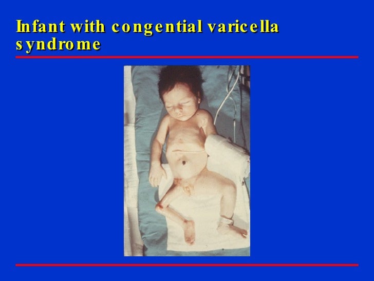 Changes Trend in Chickenpox Pregnant women and prevention with vacc…