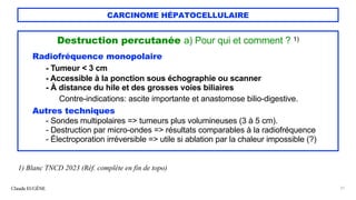 CARCINOME HÉPATOCELLULAIRE
Destruction percutanée a) Pour qui et comment ? 1)
Radiofréquence monopolaire
- Tumeur < 3 cm
- Accessible à la ponction sous échographie ou scanner
- À distance du hile et des grosses voies biliaires
Contre-indications: ascite importante et anastomose bilio-digestive.
Autres techniques
- Sondes multipolaires => tumeurs plus volumineuses (3 à 5 cm).
- Destruction par micro-ondes => résultats comparables à la radiofréquence
- Électroporation irréversible => utile si ablation par la chaleur impossible (?)
Claude EUGÈNE 31
1) Blanc TNCD 2023 (Réf. complète en fin de topo)
 