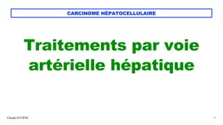 CARCINOME HÉPATOCELLULAIRE
Traitements par voie
artérielle hépatique
Claude EUGÈNE 33
 