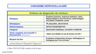 CARCINOME HEPATOCELLULAIRE
Claude EUGÈNE 7
Critères du diagnostic de cirrhose
Cliniques
Érythème palmaire, angiomes stellaires, ictère
Hépatomégalie à bord tranchant, splénomégalie
Circulation collatérale, ascite
Biologiques TP, plaquettes, albuminémie
Endoscopiques Varices oesophagiennes
Imagerie Dysmorphie hépatique, circulation collatérale
Tests sanguins non invasifs a)
Élastométrie (Fibroscan*)
Valeur non établie en cas de tumeur du foie 1)
Biopsie du foie
Si absence d'arguments clinique, radiologique et
biologique pour une cirrhose 1)
a) Dont Fibrotest*, Fibromètre*, Hepascore*,
1) Blanc TNCD 2023 (Réf. complète en fin de topo)
 