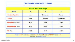 CARCINOME HEPATOCELLULAIRE
Claude EUGÈNE 76
Score de Child-Pugh
Points 1 2 3
Encéphalopathie non Confusion Coma
Ascite non Minime Abondante
Bilirubine (mcmol/L) < 35 35-50 > 50
Albuminémie (g/L) > 35 28-35 < 28
TP (%) > 50 40-50 < 40
Score 5-6 => classe A / score 7-9 => classe B / score 10-15 => classe C
Calculable sur medicalcul.free.fr
 