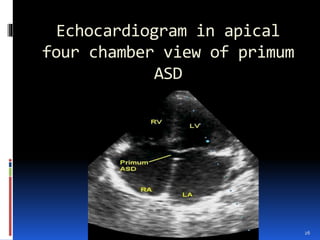 CONGENITAL HEART DISEASES | PPTX