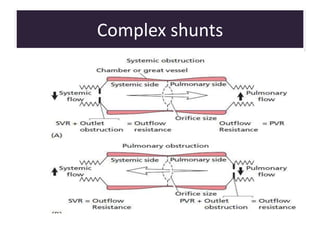 Complex shunts
• Fixed outflow obstruction present @
valvular, subvalvular, supravalvular level
or in major vessals eg TOF
 