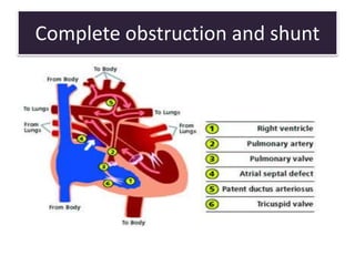 Complete obstruction and shunt
Complete obstruction to flow of blood
Shunting proximal to obstruction occurs
A downstream shunt provides flow to the
obstructed side of circulation.depends on
SVR & PVR
Eg PS with ASD & PDA
 