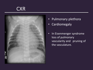 CXR
• Pulmonary plethora
• Cardiomegaly
• In Eisenmenger syndrome
loss of pulmonary
vascularity and pruning of
the vasculature.
 