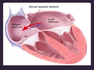 Shunt lesions
Cardiac shunting is the process whereby venous return into one
circulatory system is recirculated through the arterial outflow of the
same circulatory system
Flow of blood from the systemic venous (right) atrium (RA) to the
aorta
Flow of blood from the pulmonary venous (left) atrium (LA) to the
pulmonary artery (PA)
Pathophysiology of congenital heart disease
 