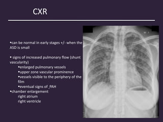 CXR
can be normal in early stages +/- when the
ASD is small
 signs of increased pulmonary flow (shunt
vascularity)
enlarged pulmonary vessels
upper zone vascular prominence
vessels visible to the periphery of the
film
eventual signs of PAH
chamber enlargement
right atrium
right ventricle
 