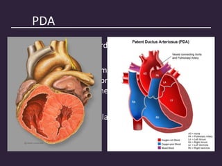 PDA
• Most common extracardiac shunt
• Connects the main pulmonary trunk near the origin
of the left PA with the proximal descending aorta just
distal to the origin of the left subclavian artery
• Left RLN lies in close relation
 
