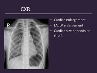 CXR
• • Cardiac enlargement
• LA, LV enlargement
• Cardiac size depends on
shunt
 