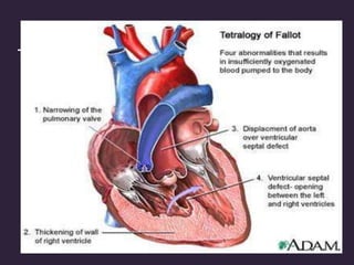Tetrology of fallot
• Most common cyanotic cardiac lesion
• The four constituents are
• VSD
• RVH and RVOT Obstruction
• Overriding aorta
• Pulmonary stenosis and pulmonary hypoplasia
 