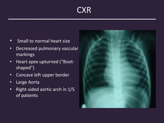 CXR
• Small to normal heart size
• Decreased pulmonary vascular
markings
• Heart apex upturned (“Boot-
shaped”)
• Concave left upper border
• Large Aorta
• Right-sided aortic arch in 1/5
of patients
• Right ventricular hypertrophy
causes the left ventricular
apex to be uplifted and cause
cardiomegaly. In addition, the
pulmonary artery segment
shadow, usually noted just
above the left atrial
appendage shadow is not
present due to small
pulmonary arteries. This give
the characteristic "Boot
shape" appearance of the
cardiac silhouette.
 