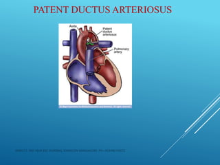 PATENT DUCTUS ARTERIOSUS
JERIN.T.S, 3RD YEAR BSC NURSING, KRSMCON MANGALORE. PH:+919496743672
 
