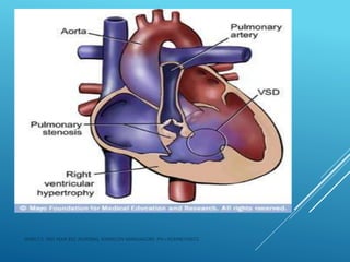 JERIN.T.S, 3RD YEAR BSC NURSING, KRSMCON MANGALORE. PH:+919496743672
 