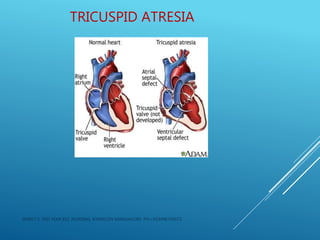 TRICUSPID ATRESIA
JERIN.T.S, 3RD YEAR BSC NURSING, KRSMCON MANGALORE. PH:+919496743672
 