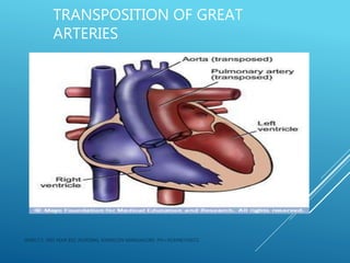 TRANSPOSITION OF GREAT
ARTERIES
JERIN.T.S, 3RD YEAR BSC NURSING, KRSMCON MANGALORE. PH:+919496743672
 