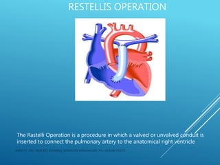 RESTELLIS OPERATION
The Rastelli Operation is a procedure in which a valved or unvalved conduit is
inserted to connect the pulmonary artery to the anatomical right ventricle
JERIN.T.S, 3RD YEAR BSC NURSING, KRSMCON MANGALORE. PH:+919496743672
 