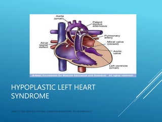HYPOPLASTIC LEFT HEART
SYNDROME
JERIN.T.S, 3RD YEAR BSC NURSING, KRSMCON MANGALORE. PH:+919496743672
 