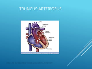 TRUNCUS ARTERIOSUS
JERIN.T.S, 3RD YEAR BSC NURSING, KRSMCON MANGALORE. PH:+919496743672
 