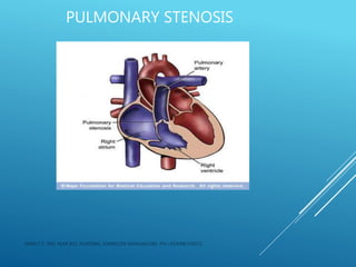 PULMONARY STENOSIS
JERIN.T.S, 3RD YEAR BSC NURSING, KRSMCON MANGALORE. PH:+919496743672
 