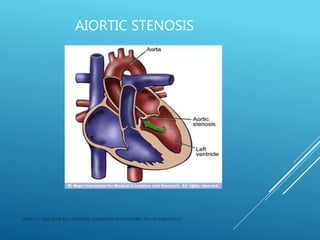 AIORTIC STENOSIS
JERIN.T.S, 3RD YEAR BSC NURSING, KRSMCON MANGALORE. PH:+919496743672
 