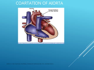 COARTATION OF AIORTA
JERIN.T.S, 3RD YEAR BSC NURSING, KRSMCON MANGALORE. PH:+919496743672
 