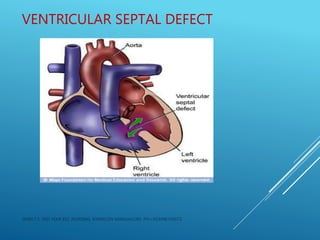 VENTRICULAR SEPTAL DEFECT
JERIN.T.S, 3RD YEAR BSC NURSING, KRSMCON MANGALORE. PH:+919496743672
 