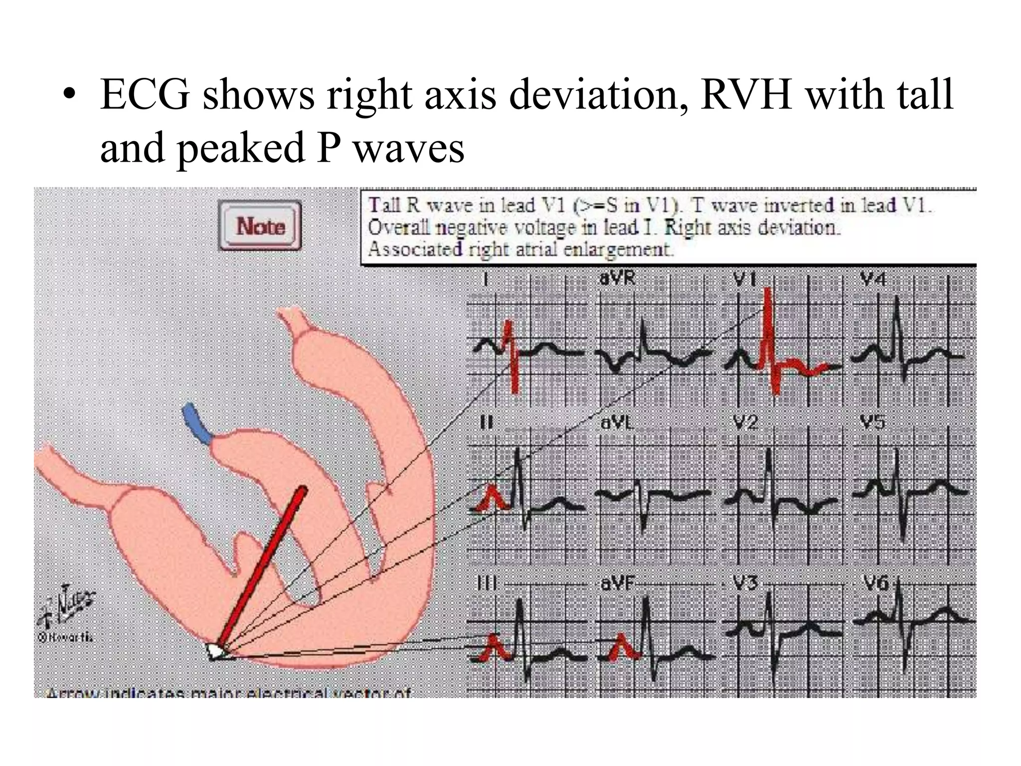 Congenital heart diseases.pptx