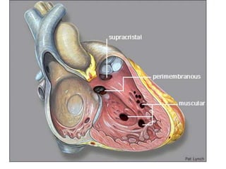 CHD.pptx