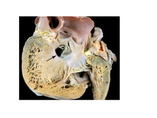 CHD.pptx