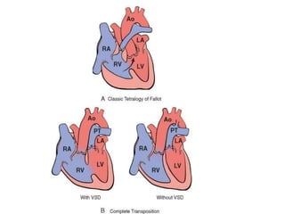 CHD.pptx