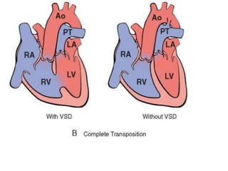 CHD.pptx