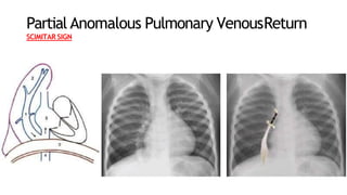 Partial Anomalous Pulmonary VenousReturn
SCIMITAR SIGN
 