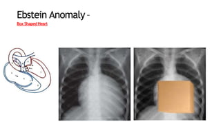 Ebstein Anomaly–
Box ShapedHeart
 