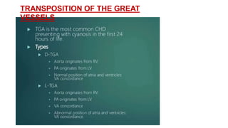 TRANSPOSITION OF THE GREAT
VESSELS
 