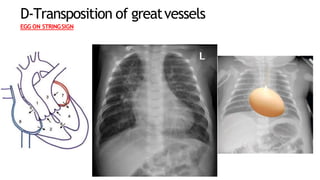 D-Transposition of greatvessels
EGG ON STRINGSIGN
 