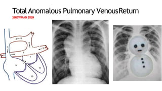 TotalAnomalous Pulmonary VenousReturn
SNOWMAN SIGN
 