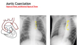 Aortic Coarctation
Figureof Three,and Reverse Figureof Three
 