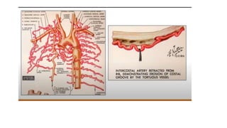 CHD CHEST X RAY.pptx