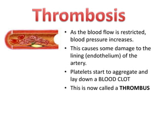 • As the blood flow is restricted,
blood pressure increases.
• This causes some damage to the
lining (endothelium) of the
artery.
• Platelets start to aggregate and
lay down a BLOOD CLOT
• This is now called a THROMBUS

 