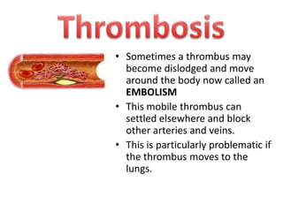 • Sometimes a thrombus may
become dislodged and move
around the body now called an
EMBOLISM
• This mobile thrombus can
settled elsewhere and block
other arteries and veins.
• This is particularly problematic if
the thrombus moves to the
lungs.

 