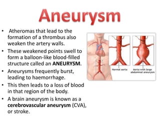 • Atheromas that lead to the
formation of a thrombus also
weaken the artery walls.
• These weakened points swell to
form a balloon-like blood-filled
structure called an ANEURYSM.
• Aneurysms frequently burst,
leading to haemorrhage.
• This then leads to a loss of blood
in that region of the body.
• A brain aneurysm is known as a
cerebrovascular aneurysm (CVA),
or stroke.

 