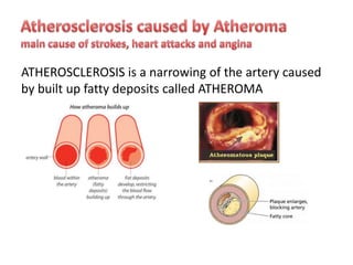 ATHEROSCLEROSIS is a narrowing of the artery caused
by built up fatty deposits called ATHEROMA

 